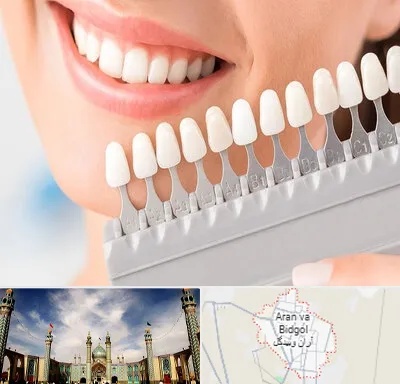متخصص لمینت دندان در آران و بیدگل