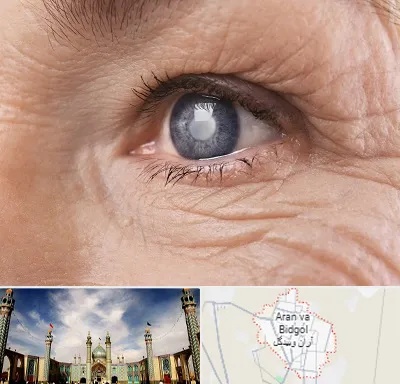 متخصص آب مروارید در آران و بیدگل