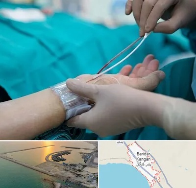 آنژیوگرافی در بندر کنگان