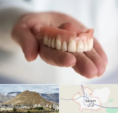 لیفت لثه با لیزر در گراش
