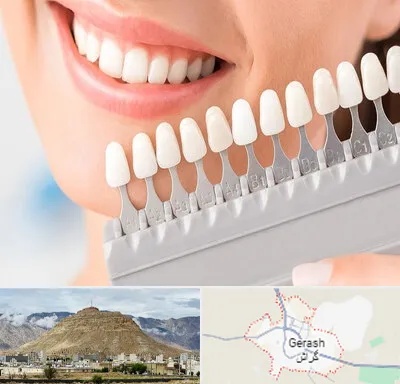 متخصص لمینت دندان در گراش