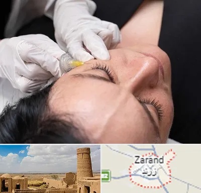 کربوکسی تراپی در زرند