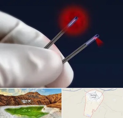 جراحی سینه با لیزر در گرمسار
