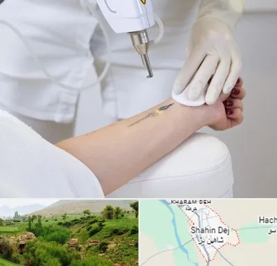 پاک کردن تتو با لیزر در شاهین دژ