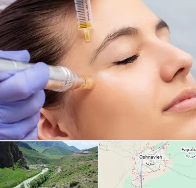 میکرونیدلینگ در اشنویه