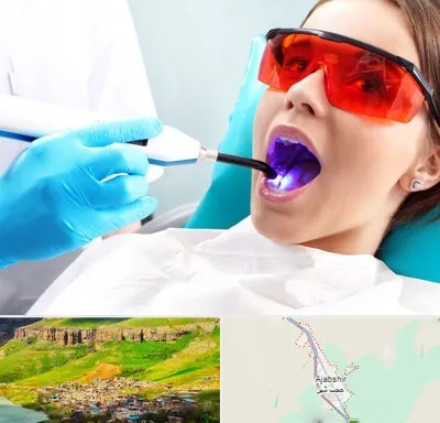 جراحی لثه با لیزر در عجب شیر