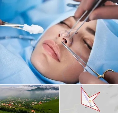 عمل ترمیمی بینی در خلخال