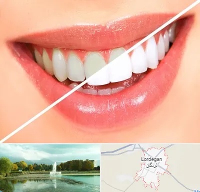 بلیچینگ دندان در لردگان
