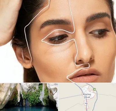عمل بینی اقساطی در خورموج