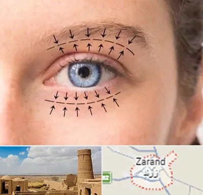 عمل افتادگی پلک در زرند