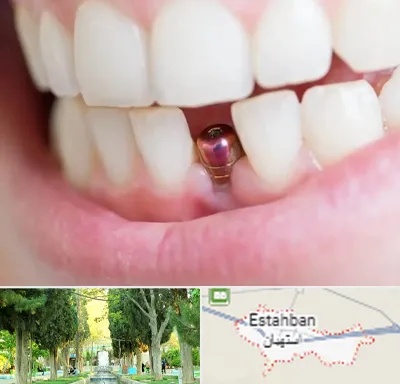 ایمپلنت اقساطی در استهبان