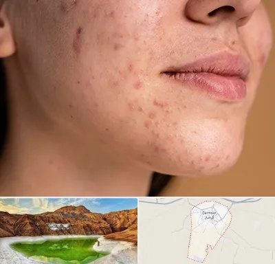 درمان جای جوش در گرمسار