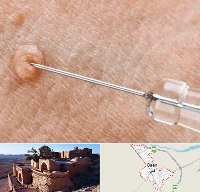 لیزر زگیل تناسلی در قائن