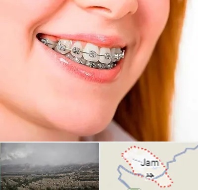 ارتودنسی ارزان در جم