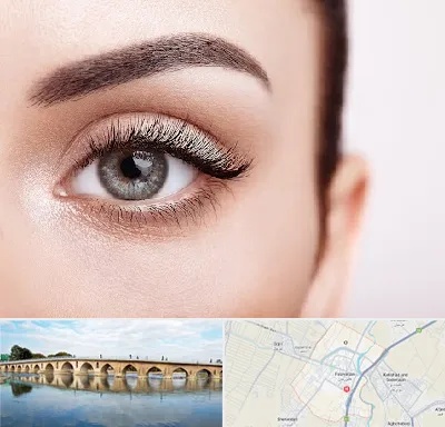 فوق تخصص عنبیه در فلاورجان