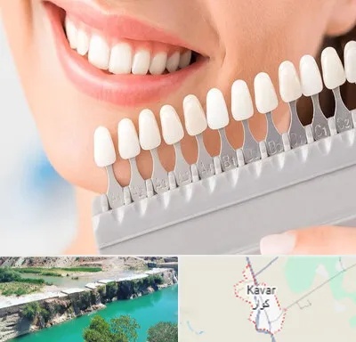 متخصص لمینت دندان در کوار