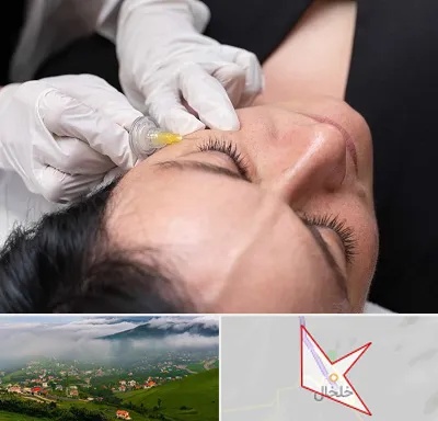کربوکسی تراپی در خلخال