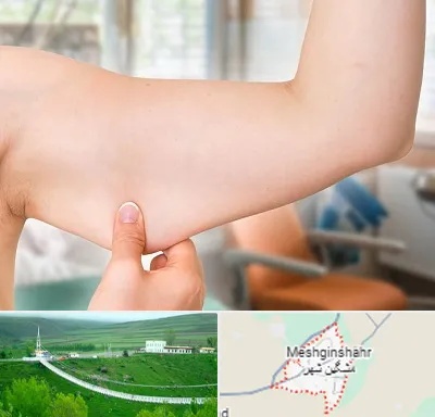براکیوپلاستی در مشگین شهر