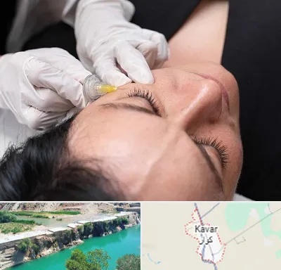 کربوکسی تراپی در کوار