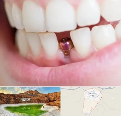 ایمپلنت اقساطی در گرمسار