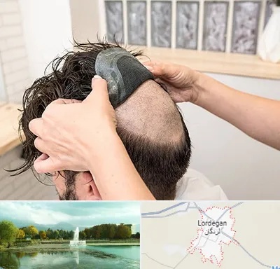 پروتز مو در لردگان