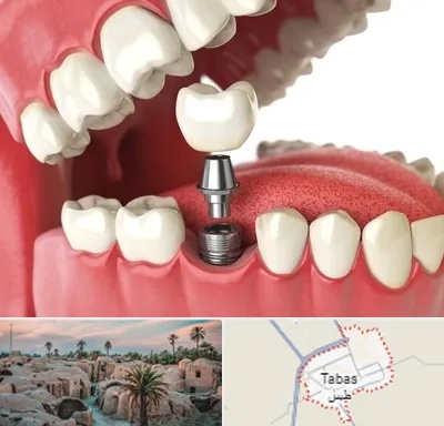متخصص پروتز دندان در طبس