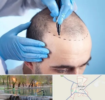دکتر کاشت مو در بروجن