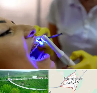 دندانپزشکی با لیزر در مشگین شهر