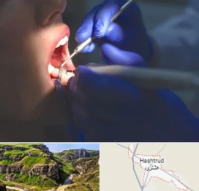 عصب کشی در هشترود