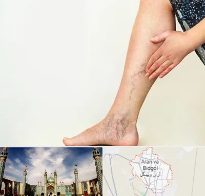 دکتر واریس در آران و بیدگل