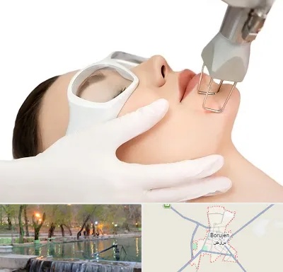 لیزر فرکشنال در بروجن