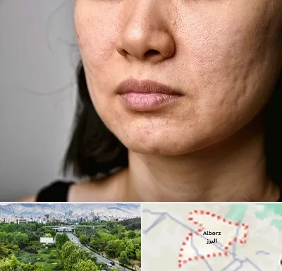سابسیژن جای جوش در البرز
