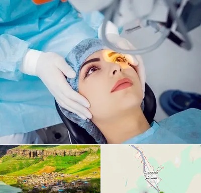دکتر عمل لیزیک چشم در عجب شیر