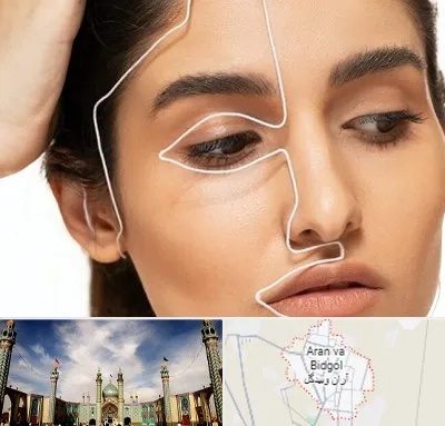 عمل بینی اقساطی در آران و بیدگل