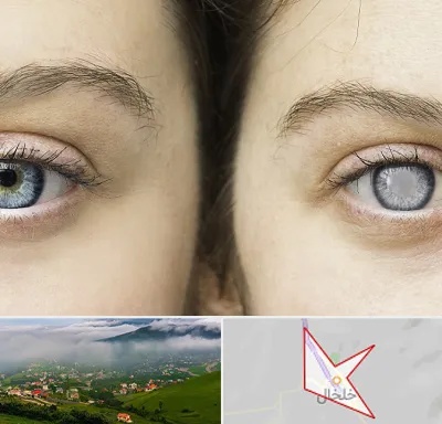 متخصص آب سیاه (گلوکوم) در خلخال