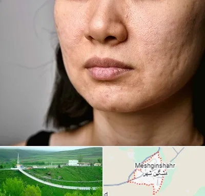 سابسیژن جای جوش در مشگین شهر