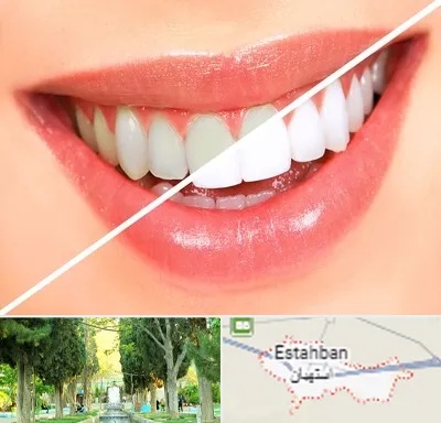 بلیچینگ دندان در استهبان
