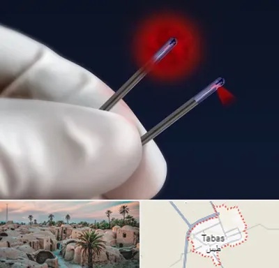 جراحی سینه با لیزر در طبس