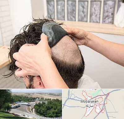 پروتز مو در مبارکه