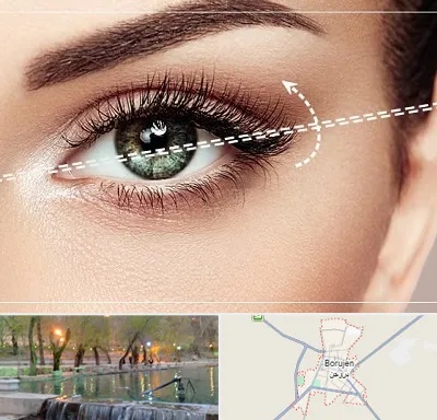 جراحی چشم گربه ای در بروجن