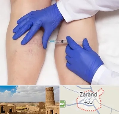 اسکلروتراپی در زرند