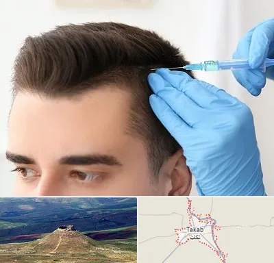 مزوتراپی مو در تکاب