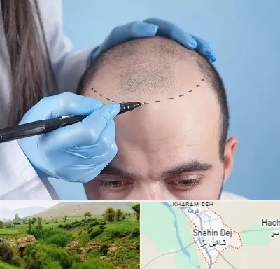 کاشت مو اقساطی در شاهین دژ