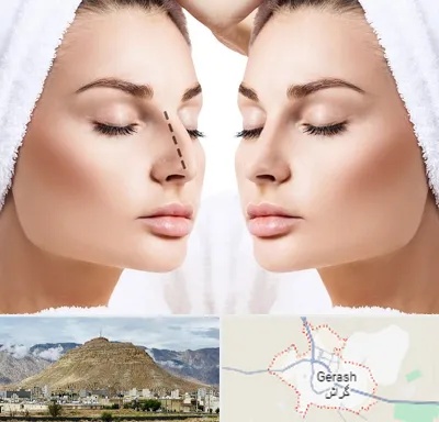 عمل بینی در گراش