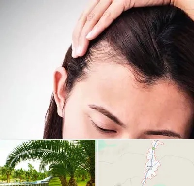 کاشت مو بانوان در کهنوج