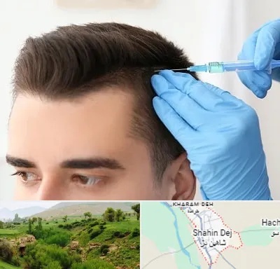 مزوتراپی مو در شاهین دژ