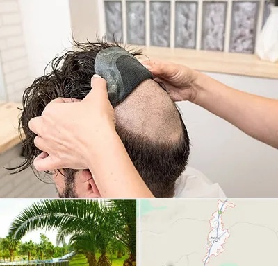 پروتز مو در کهنوج