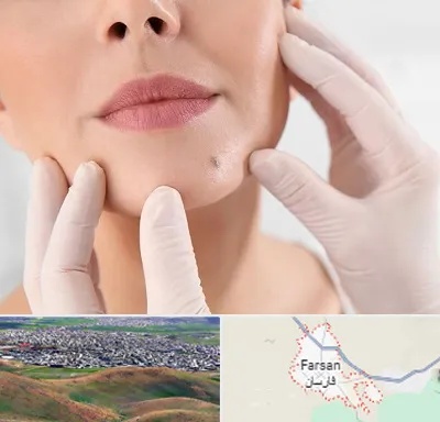 برداشتن خال در فارسان