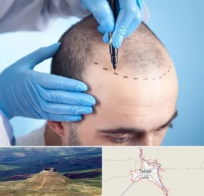 دکتر کاشت مو در تکاب