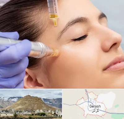 میکرونیدلینگ در گراش